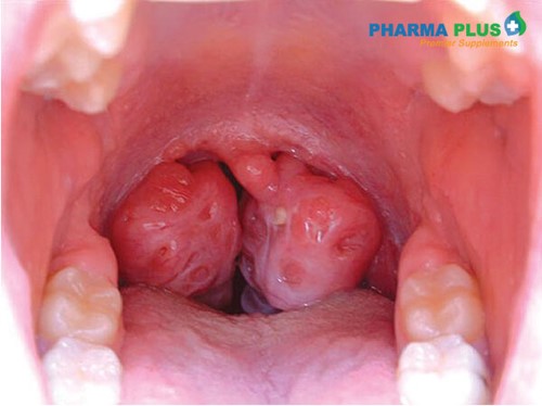 Ung thư vòm họng gây đau rát họng